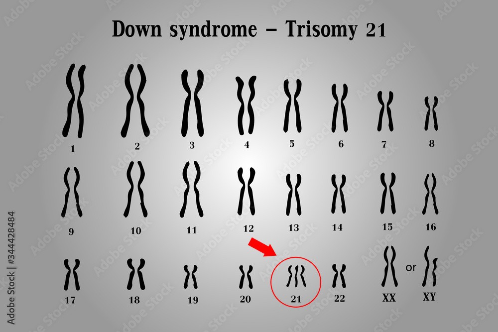 Karyotype of Down syndrome (DS or DNS), also known as trisomy 21, is a  genetic disorder caused by the presence of all or part of a third copy of chromosome  21 Stock 